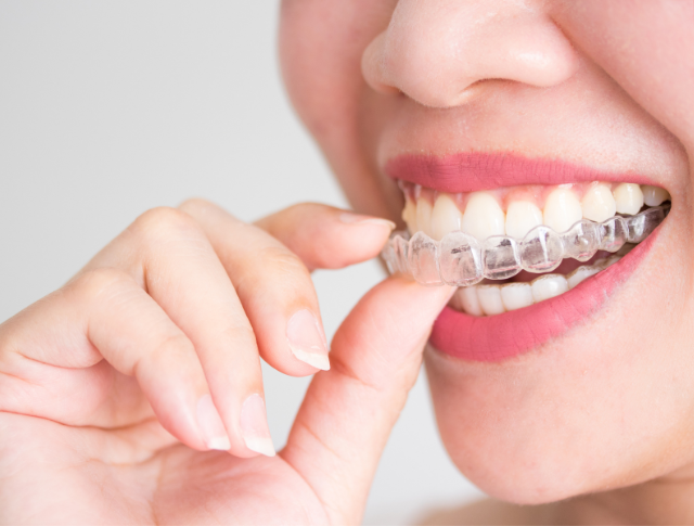 Unsichtbare Zahnspange Wien - Invisalign Wien Clear Aligners Zahnspange für Erwachsene | Clear Aligners