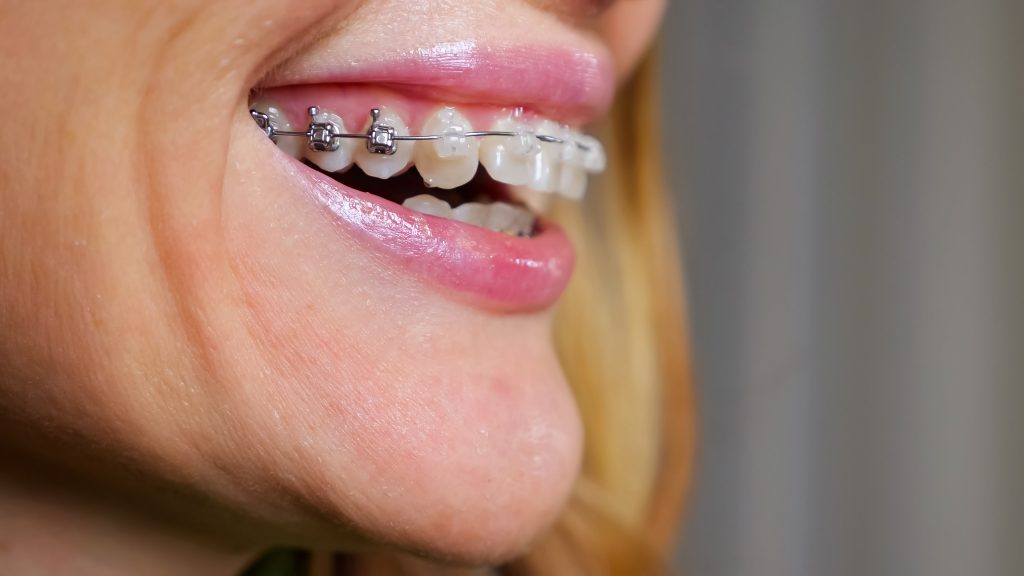 Ceramic+metal braces